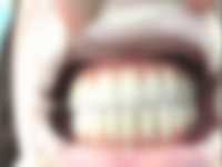 【閲覧注意】全ての歯をインプラントにしようとする患者が手術している映像がエグい...